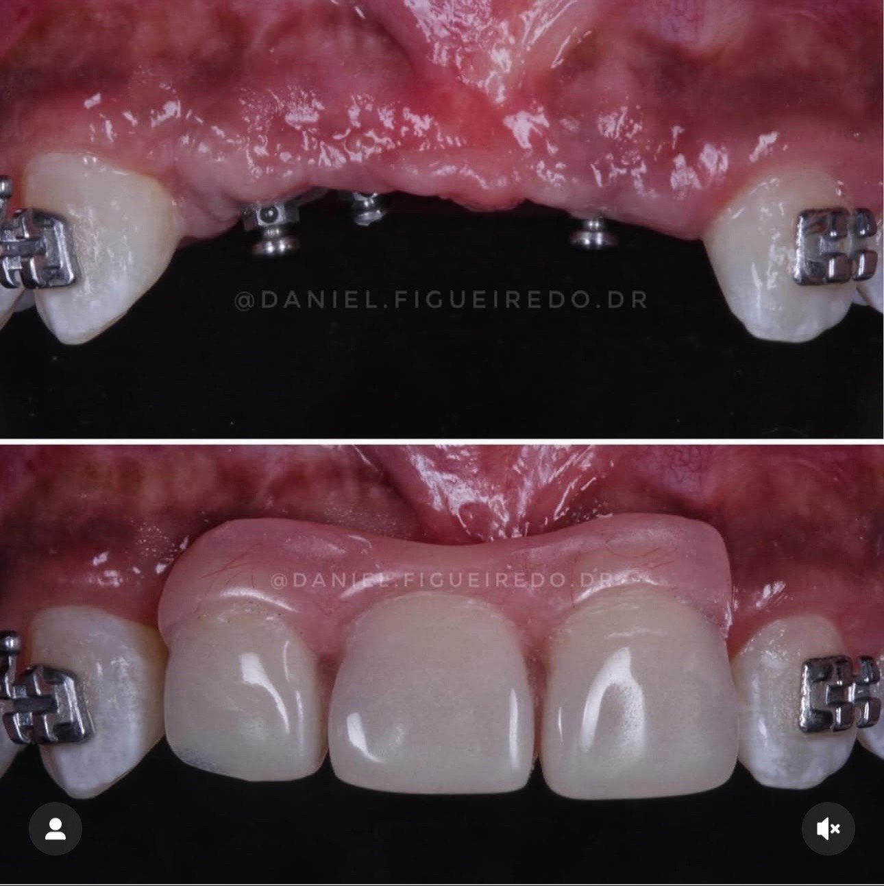 正畸过程中的过渡义齿